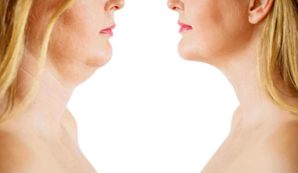 Double Chin treatment Farnborough before and after results