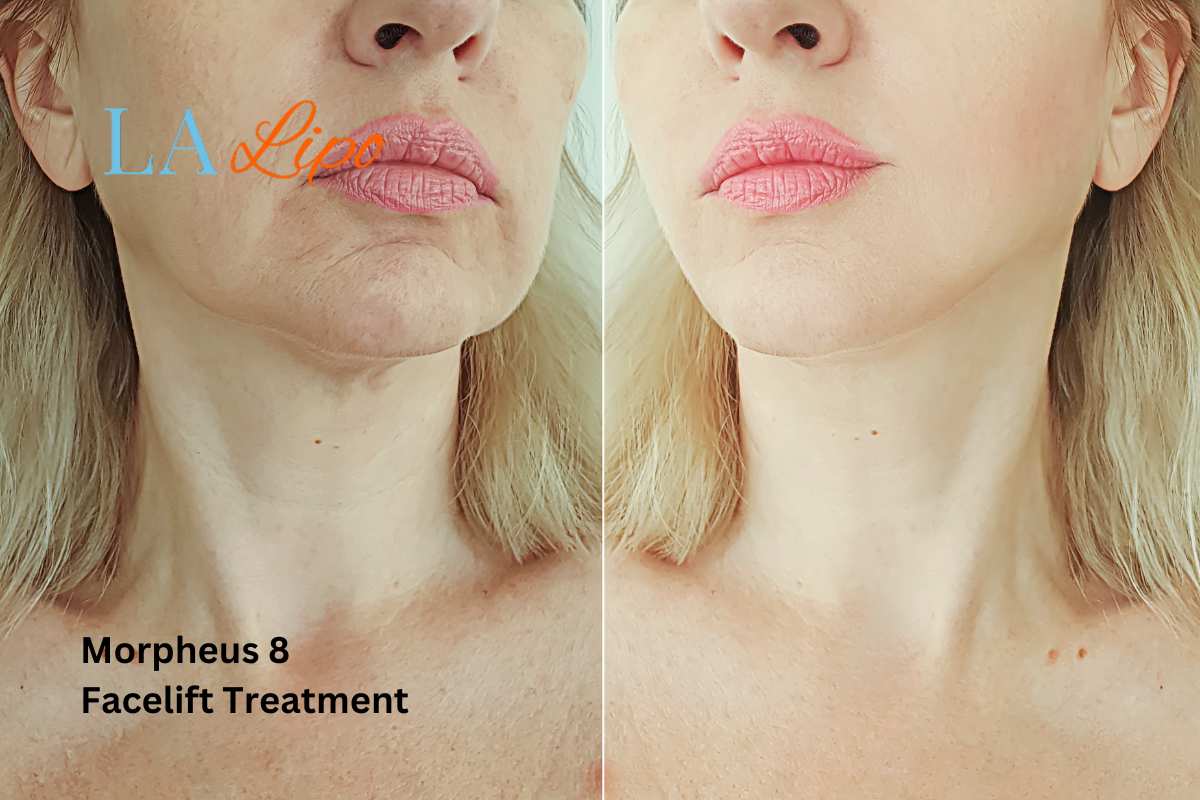 Turn back time with Morpheus8 Treatment Farnborough