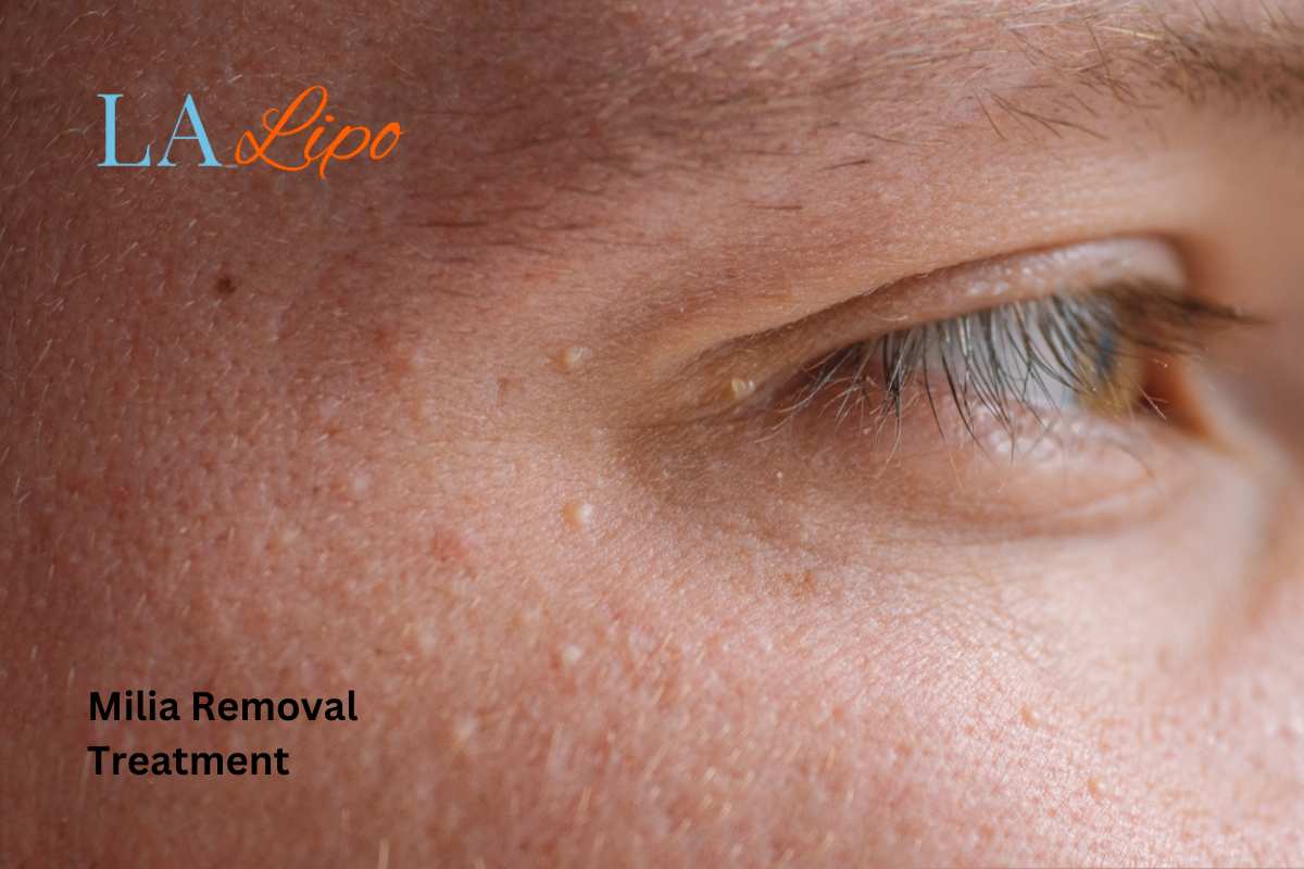 Cryopen Milia Removal: Is It the Easiest and Safest Option Farnborough?