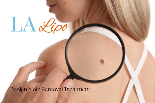 Woman having her inspection of blemish before mole removal Farnborough