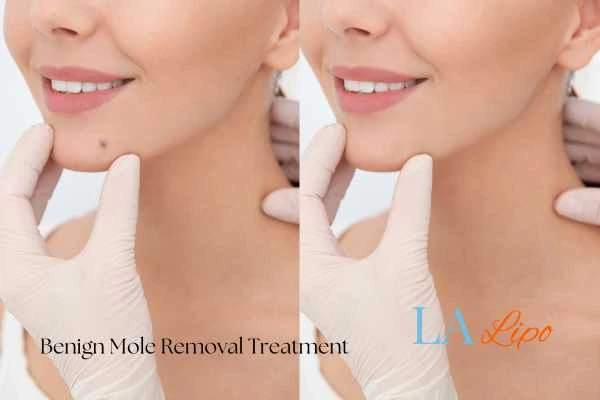woman's before and after mole removal Farnborough results