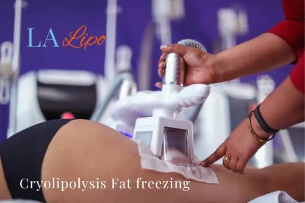 women getting fat freezing Farnborough