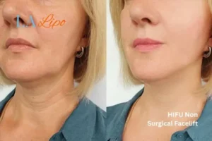 hi-fu for wrinkles Farnborough before and after results
