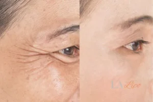 Before and after results of woman - HI-fu wrinkles reduction treatment Farnborough