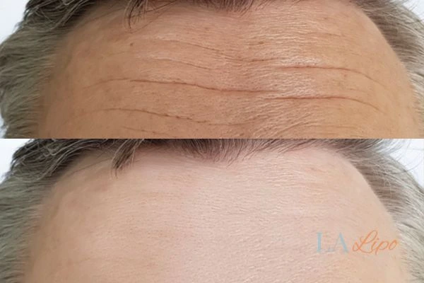 results of HIFU Farnborough on mans forehead to help reduce lines and wrinkles