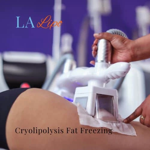fat freezing - Cryolipolysis Farnborough