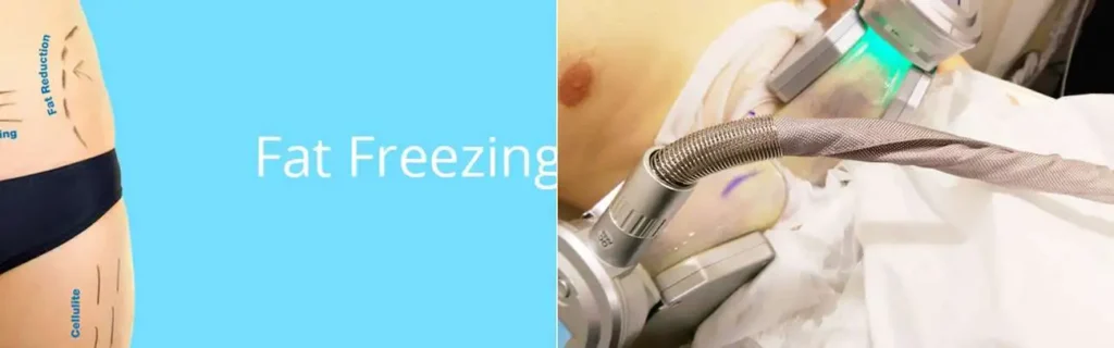 multi areas of a persons body having coolsculpting Farnborough treatment