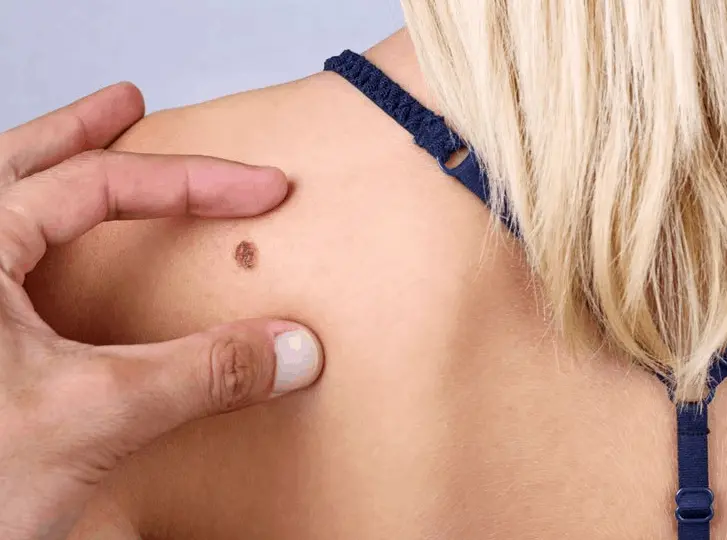 woman having mole removal Farnborough consultation before treatment.