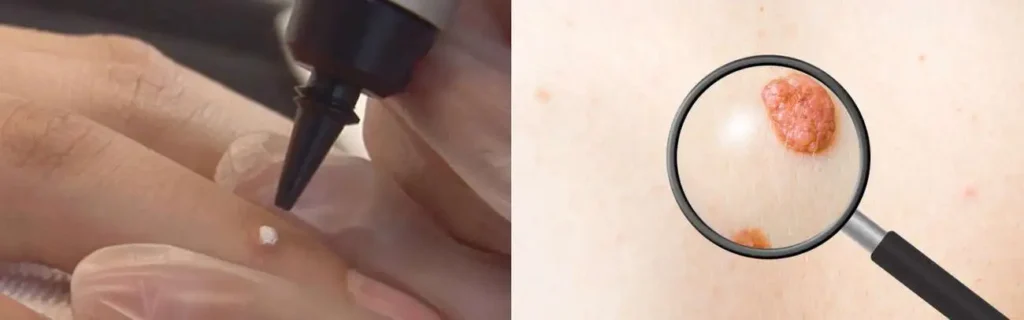 Cryopen for mole removal Farnborough - speak to our team today!