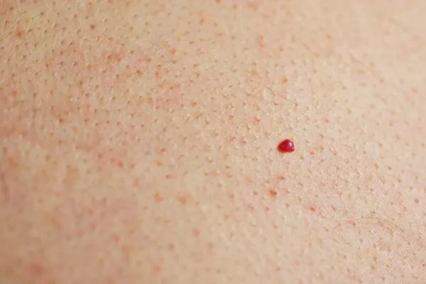 close up of a cherry angioma Farnborough