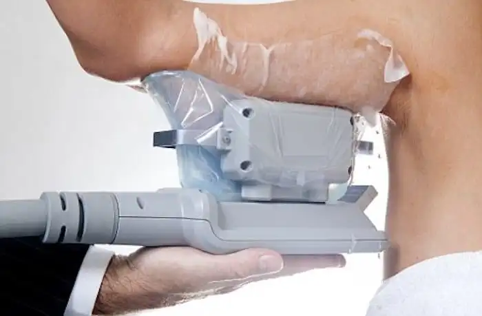 Picture of fat freezing Farnborough on the upper arms.