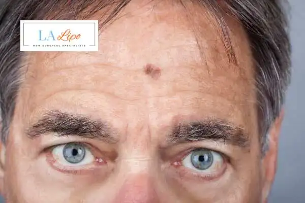 Solar Lentigo Removal Farnborough image of man with mark on his forehead