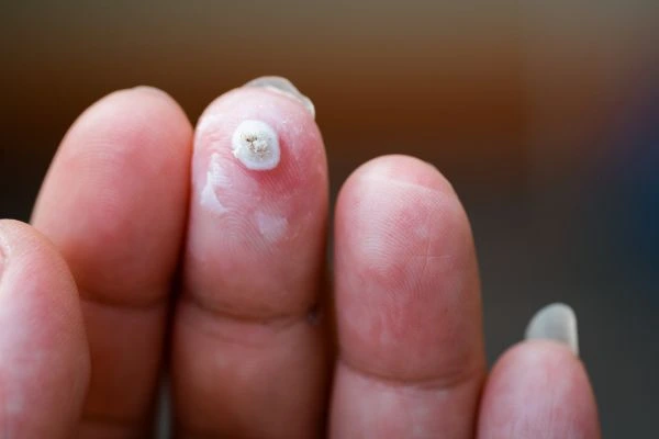 wart on person finger - cryotherapy to treat from LA LIPO Farnborough