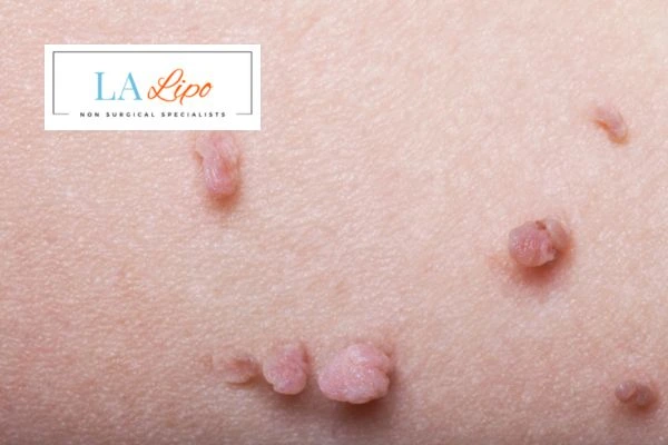 Does cryopen skin tag removal Farnborough hurt? Find out now call our team today!