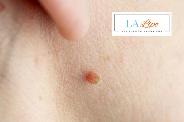 Book skin tag removal Farnborough today speak to our team now!