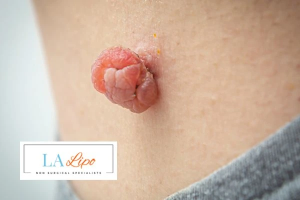 Interested in skin tag removal Farnborough? Concerned about the pain? Find out more today!
