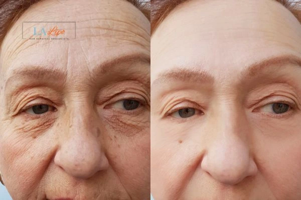 The powerful benefits of Morpheus8 Treatment Farnborough - Call Our team today!