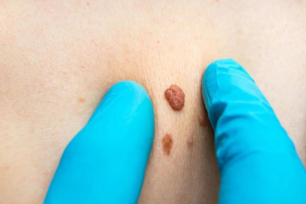 LA LIPO Cryopen Lesion Removal Prices Farnborough
