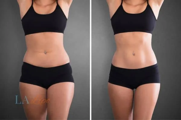 before and after results of non-surgical treatment to help a woman's body image and mental health Farnborough