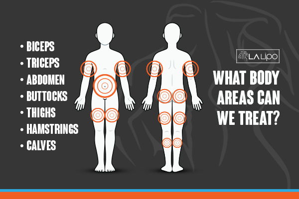 Diagram to show areas you can have LA-EMS Body Sculpting Treatment Farnborough