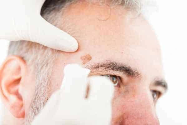 Age spots and elderly people Farnborough what is the link?