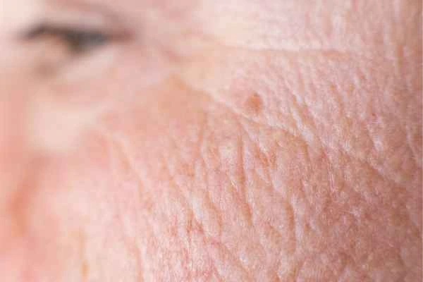 close up picture of a woman's face showing an age spot Farnborough