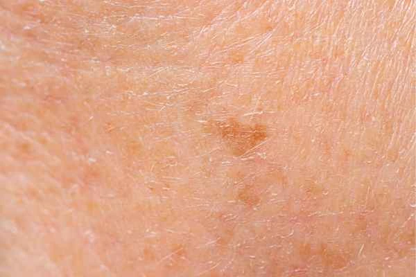 close up picture of age spots Farnborough