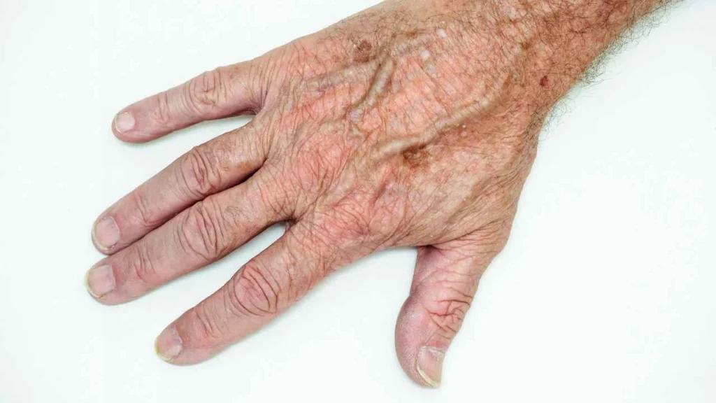 Male hand showing age spot Farnborough