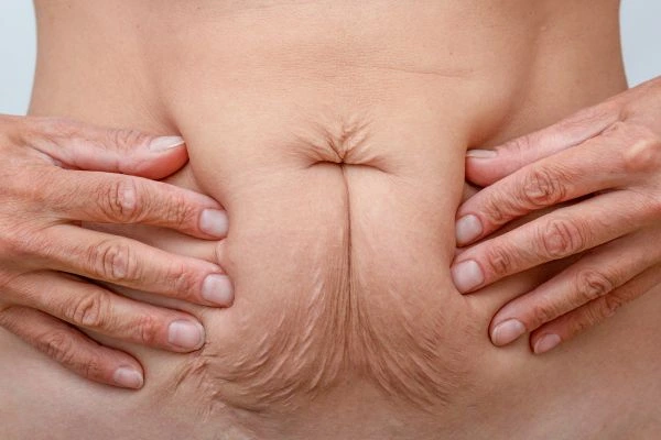 Should I Combine Diastasis Recti Treatment with Body Contouring for Better Results Farnborough?