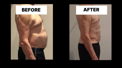 What Symptoms Can Diastasis Recti Cause in Men? Weak Core, Back Pain and Poor Posture Farnborough
